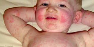 Erythema Infectious - Hình ảnh minh họa